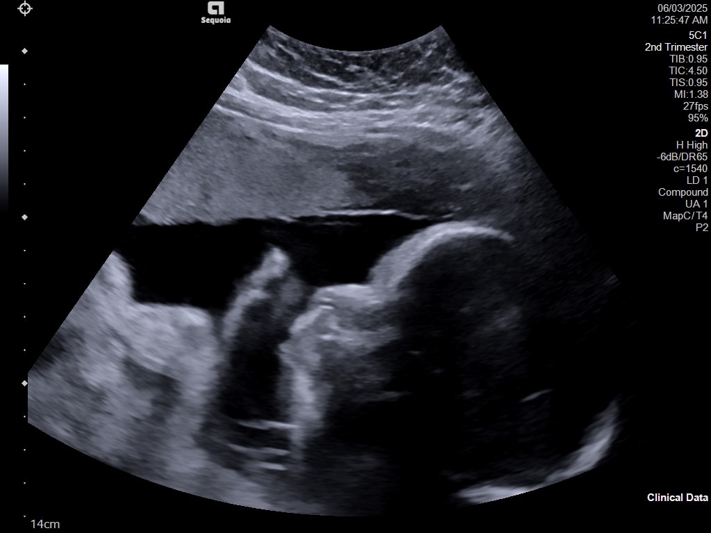 Gestational age 29weeks