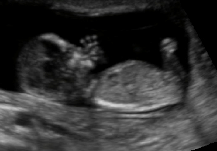 reduce gestational weight gain