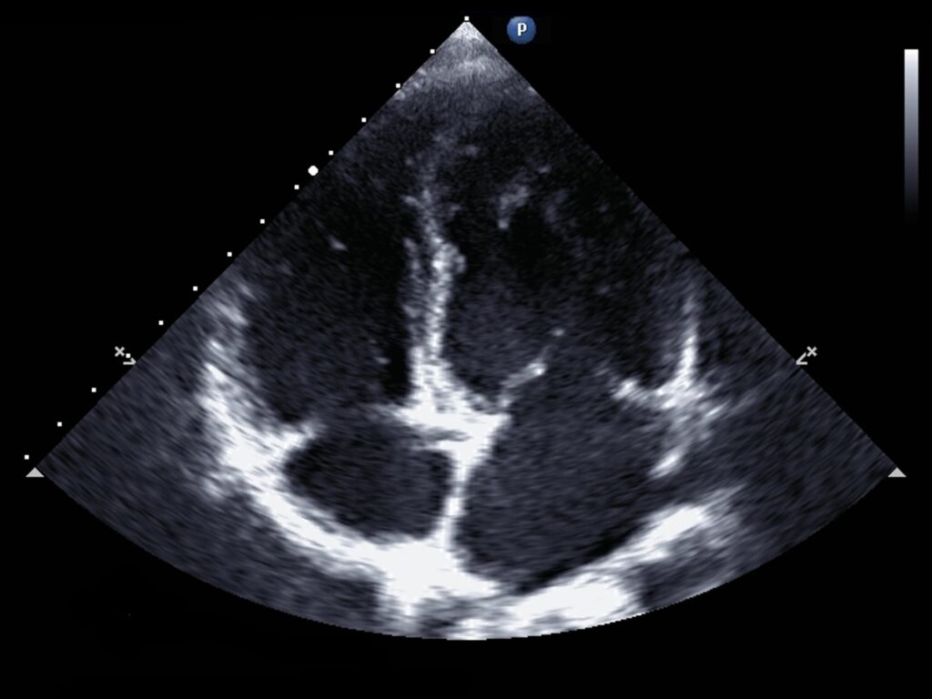 Transthoracic echocardiography
