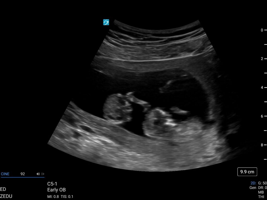 ultrasound assessment