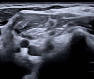 Ultrasound-Guided Regional Anaesthesia
