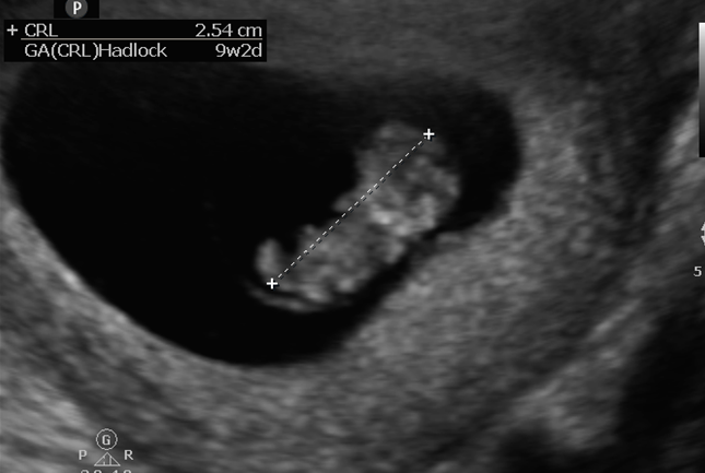 Zedu early pregnancy point of care ultrasound training emergency medicine course