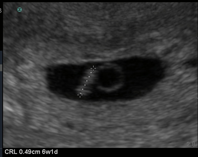Zedu confirm an intrauterine pregnancy iup ultrasound training course 