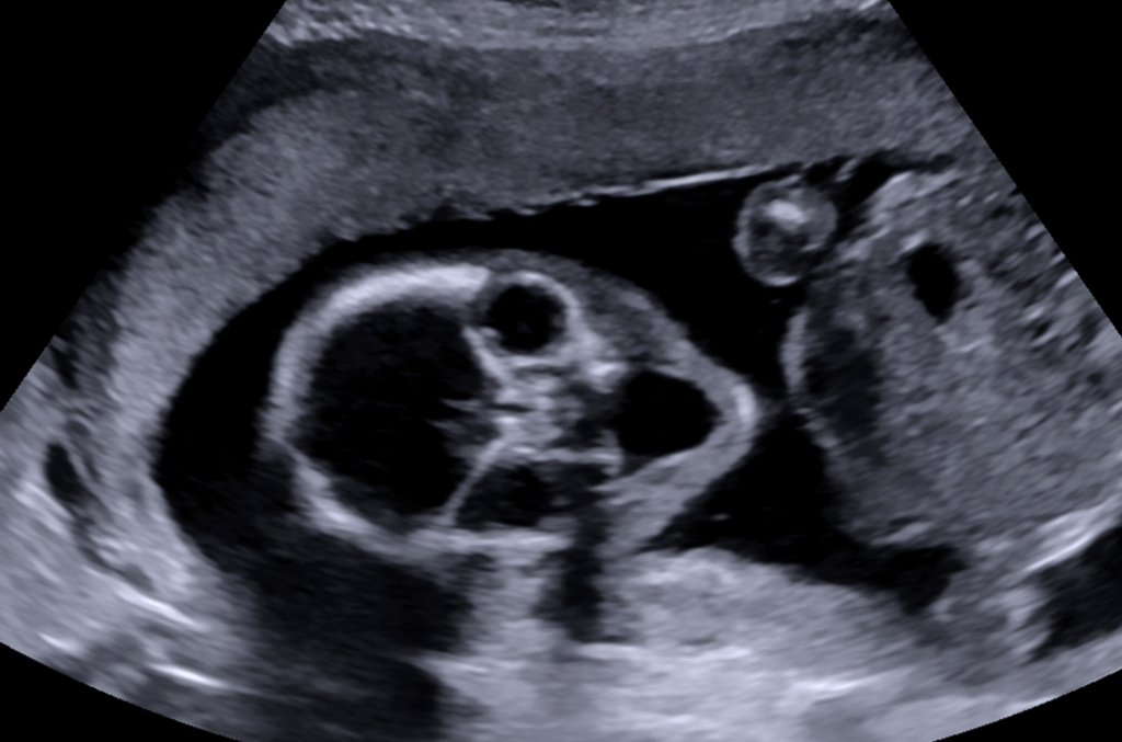 zedu obstetric ultrasound above criteria