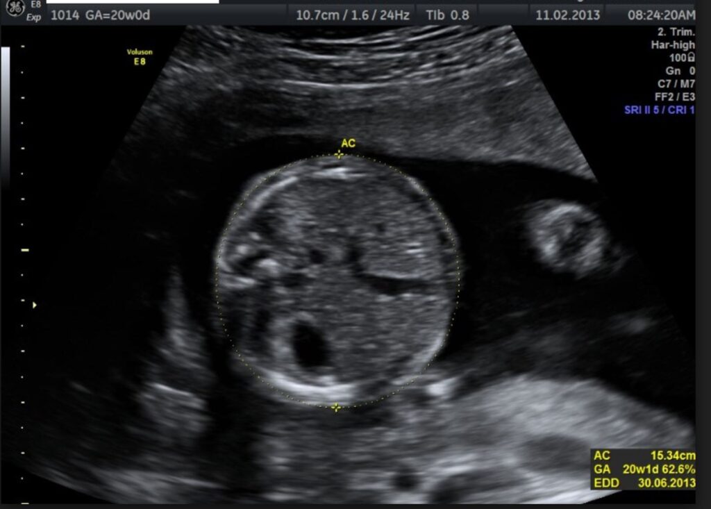 Zedu 2nd trimester ultrasound fast-track for sonographers umbilical artery